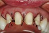 Figure 9  Facial view of tooth Nos. 7 through 10 after completion of the surgical phase of treatment.
