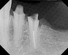 Figure 16  After initial positioning of the bone, keeping the tip of the laser in intimate contact with the root surface, a slight troughing of the bone was seen on radiographic examination.