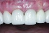 Fig 17. The all-ceramic<a id="x.149419" /> crown was cemented on the definitive abutment.