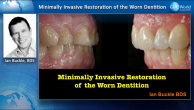 Minimally Invasive Restoration of the Worn Dentition Webinar Thumbnail