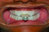 Fig 1. A prefabricated MAD (myTAP™, Airway Management, tapintosleep.com) is fit to the teeth chairside in 15 minutes.