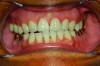 Fig 6. Photograph of teeth maximally intercuspated 1 year after patient began treatment with a MAD (Herbst appliance). With the jaw advanced 80% of maximum protrusion, the AHI was reduced to 1.4 events/hr. Compared to the pre-treatment occlusion (Figure 5), overbite and overjet had each decreased 2 mm.