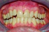 Fig 8. Photograph of teeth maximally intercuspated 10 months after patient began treatment with a MAD (TAP® appliance). With the jaw advanced 95% of maximum protrusion, the AHI in the supine position was reduced to 1.1 events/hr. A posterior open bite was observed on both sides of the dental arch.