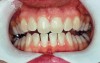 Fig 3. Prior to at-home whitening. (Photograph courtesy of Kimberly Marshall, DDS. Originally published in: Marshall, K, Berry TG, Woolum J. Teeth Whitening Considerations. Inside Dental Assisting. 2012;8(1). © AEGIS Publications, LLC. Used with permission.)