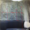 Fig 1. Periapical radiograph revealing inflammation distal to the bicuspid root. Red lines help indicate location of each implant.