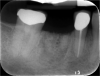Fig 6. Periapical radiograph, single missing tooth.