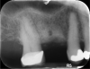 Fig 11. Site No. 3, 6 months after extraction and bone grafting completed.