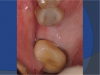 Fig 12. Sufficient attached mucosa was evident after 6 months of healing.