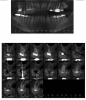 Fig 14. Panoramic radiograph and CBCT scan taken with radiographic guide in place.