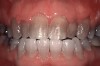Fig 1. Teeth with tetracycline stains before whitening treatment. (Photograph courtesy of Marcos Vargas, DDS, MS. Originally published in: da Costa JB. The Tooth-Whitening Process: An Update. Compendium. 2012;33(10). © AEGIS Publications, LLC. Used with permission.)