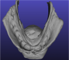 Fig 6. Scanned mandibular impression.