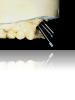 Figure 9. In the presence of angulation problems or implants placed in the wrong location, cement-retained restorations are often required.