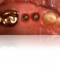 Figure 20. Upon removal of the healing caps, each site exhibited a deep sulcus, making “screwmentable” abutment/crown restorations ideal in order to avoid retentive cement subgingivally.