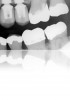 Figure 28. Radiograph taken 4 years after placement demonstrating stable and healthy peri-implant bone and no indication of peri-implant disease.