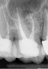 Fig 2. Good candidate for socket preservation.