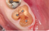 Fig 3. A nonrestorable molar.