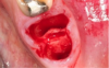 Fig 5. Atraumatic tooth removal.