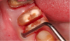 Fig 7. Periodontal ligament loosened.