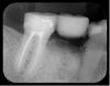 Fig 15. Radiograph showing radiopacity of material.