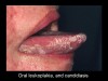 Figure 6. Leukoplakia (Image courtesy of AIDS Image Library <a href="http://www.aidsimages.ch" target="_blank">www.aidsimages.ch</a>).