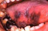 Figure 9. Melanoma (Courtesy of <a href-"http://doctorspiller.com" target="_blank">http://doctorspiller.com</a>).