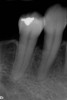 Fig 6. A radiograph taken at 10 years postoperatively demonstrates the predictable longevity of using PDGF for grafting procedures, as healthy bone support is observed.