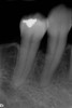 Fig 6. A radiograph taken at 10 years postoperatively demonstrates the predictable longevity of using PDGF for grafting procedures, as healthy bone support is observed.