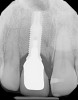 Fig 11. The success and efficacy of this approach was confirmed radiographically at 8 years post-treatment, as demonstrated by the stable gingival margins, thickened biotype with a connective tissue graft, and stable bone levels observed at the first thread of the fixture.