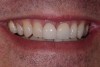 Fig 16. Close-up view of the patient’s gingival architecture following tissue graft healing.