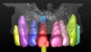 Fig 18. Three-dimensional implant treatment planning software was used to ensure implant placement accuracy.