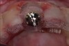 Fig 20. The implant was placed immediately following extraction according to the treatment plan.