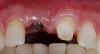 Fig 24. View of the uncovered implant and now-prepared adjacent tooth for finalizing prosthetic treatment