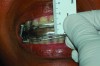 Fig 9. The MAD is fabricated with an anterior vertical dimension 1.5 mm greater than the construction bite.