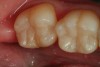 Figure 3. An occlusal view of tooth numbers 18 and 19 after anatomic placement of the enamel “capping” layer (Xtra-Fil: VOCO America), finishing, and polishing.