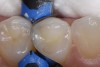 Figure 5. A bulk fill composite (Beautifil Bulk Fill Restorative: Shofu) is used to complete the occlusal aspect of the restoration.
