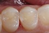Figure 6. An occlusal view of the completed distal occlusal composite restoration on tooth number 5.