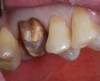 Fig 15. The tooth was prepared for a milled lithium-disilicate full-coverage crown restoration.