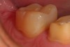 Figure 9. A two-week post operative view of the mesial occlusal bulk filled composite restoration in tooth number 31 prior to placement of the ceramic restoration on tooth number 30. Note the seamless margin between the restorative material and the tooth with no manipulation or “condensing” of the composite material during placement.