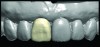 Fig 2. Proposed digital design of the diagnostic waxup of tooth No. 8.