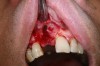 Fig 1. Tooth extraction resulted in a defected wall.
