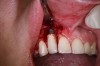 Fig 3. An implant that was placed too far buccally resulted in a ridge defect that required disinfection and cleaning of the exposed surface.