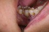 Fig 5. Patient presented with a periodontal defect.