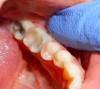 Figure 2 Palpation testing on tooth No. 19 performed by pressing index finger around the buccal and lingual gingiva.