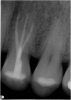 Fig 14. Three-rooted premolar displaying how difficult anatomy can obscure a clinician from visualizing the apex of the tooth.
