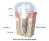 Figure 1 – Comparison between the tooth (left side) and implant (right side) attachment into bone (Courtesy of Nobel Biocare)