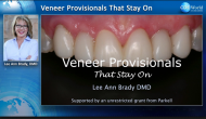 Veneer Provisionals That Stay On Webinar Thumbnail