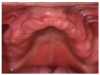 An upper denture
ridge with good morphology.