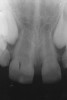 Fig 3. Radiographic scan of fused maxillary central-peg lateral incisors, teeth Nos. 7 and 8, and congenitally missing lateral incisor, tooth No. 10.