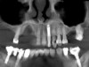 Fig 3. CAT scan showing how thin the palatal bone plate was and the extent of the defect. A small fenestration at the palatal bone plate level was visible.