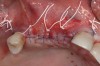 Fig 7. Three horizontal mattress sutures were placed, followed by a series of very thin, interrupted stitches.